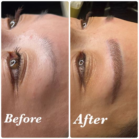 費用：1回目¥65,000＋2回目¥60,000＝計¥125,000（通常料金）<br>
治療期間と回数：約1ヶ月、計2回（1回目の施術から1ヶ月後に2回目の施術）<br>
副作用やリスク：赤み、腫れ、内出血、痛み、痒み、乾燥など<br>
