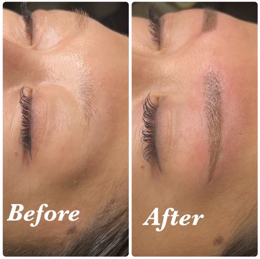 費用：1回目¥65,000＋2回目¥60,000＝計¥125,000（通常料金）<br>
治療期間と回数：約1ヶ月、計2回（1回目の施術から1ヶ月後に2回目の施術）<br>
副作用やリスク：赤み、腫れ、内出血、痛み、痒み、乾燥など<br>
