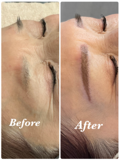 費用:1回目¥65,000+2回目¥60,000=計¥125,000(通常料金)<br>
治療期間と回数:約1ヶ月、計2回(1回目の施術から1ヶ月後に2回目の施術)<br>
副作用やリスク:赤み、腫れ、内出血、痛み、痒み、乾燥など<br>