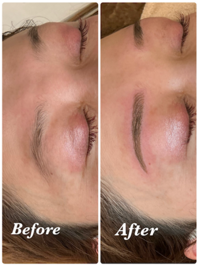 費用:1回目¥65,000+2回目¥60,000=計¥125,000(通常料金)<br>
治療期間と回数:約1ヶ月、計2回(1回目の施術から1ヶ月後に2回目の施術)<br>
副作用やリスク:赤み、腫れ、内出血、痛み、痒み、乾燥など<br>